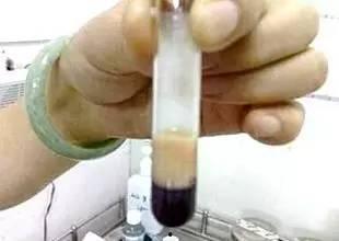 乳糜血图片,揭示营养吸收奥秘